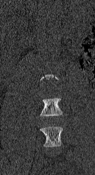 Burst fracture (Radiopaedia 53373-59357 Coronal bone window 6).jpg