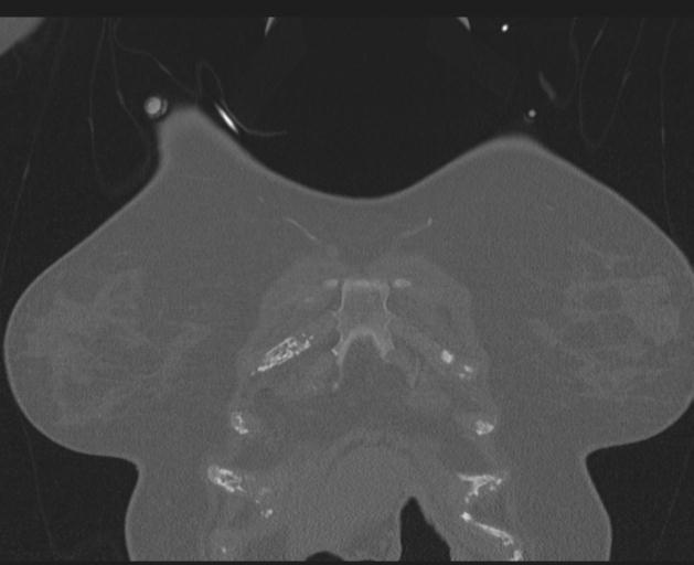 Burst fracture - thoracic spine (Radiopaedia 30238-30865 Coronal bone window 22).jpg