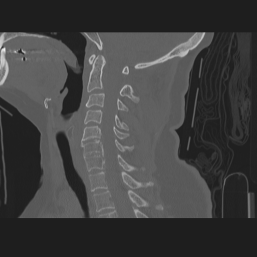 C2 fracture (Radiopaedia 34091-35341 Sagittal bone window 37).png