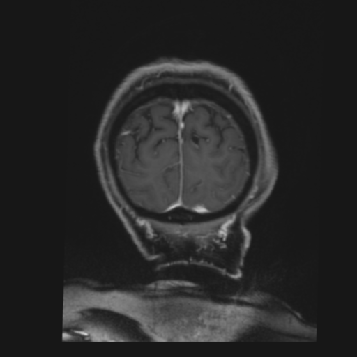 CNS lymphoma with steroid response (Radiopaedia 37980-39921 Coronal T1 C+ 47).png