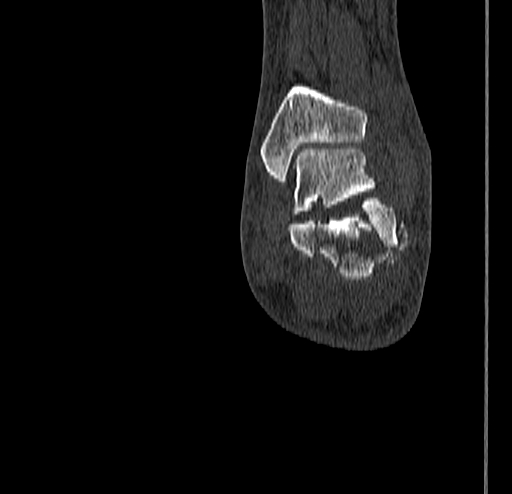 File:Calcaneal fracture - Sanders type 4 (Radiopaedia 90179-107370 Coronal bone window 70).jpg