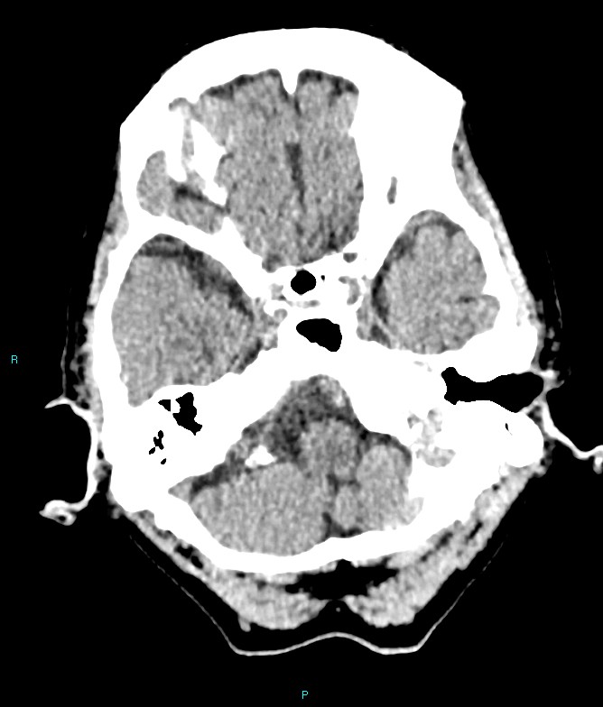 Calcified cerebral emboli from left ventricular thrombus (Radiopaedia 84420-99758 Axial non-contrast 74).jpg