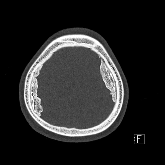Calcified chronic subdural hematoma (Radiopaedia 77374-89492 Axial bone window 116).jpg