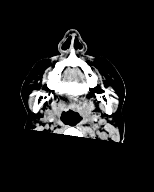 Calcified meningioma (Radiopaedia 74361-85243 Axial non-contrast 66).jpg