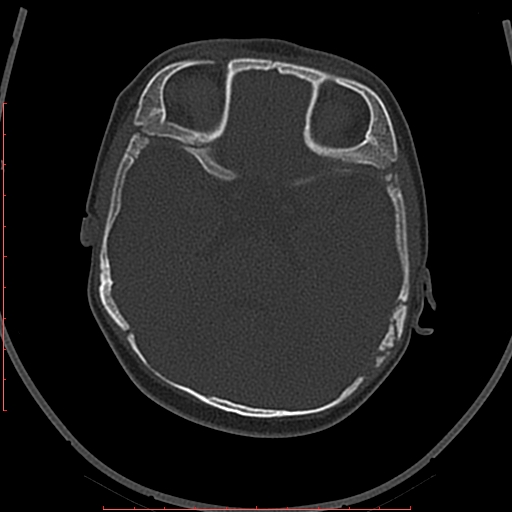 Calcified middle cerebral artery embolism (Radiopaedia 78949-91860 Axial bone window 14).jpg