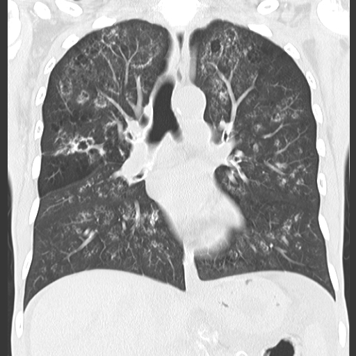 File:Calciphylaxis and metastatic pulmonary calcification (Radiopaedia 10887-11318 Coronal lung window 2).jpg