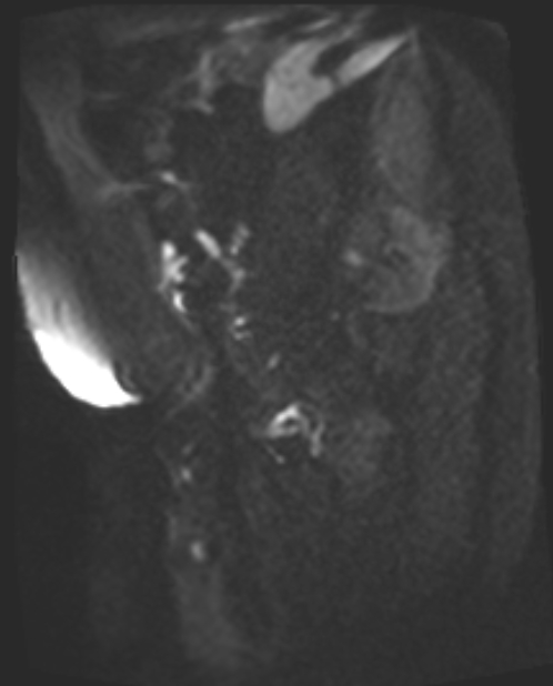 Cancer cervix - stage IIb (Radiopaedia 75411-86615 Sagittal DWI 47).jpg