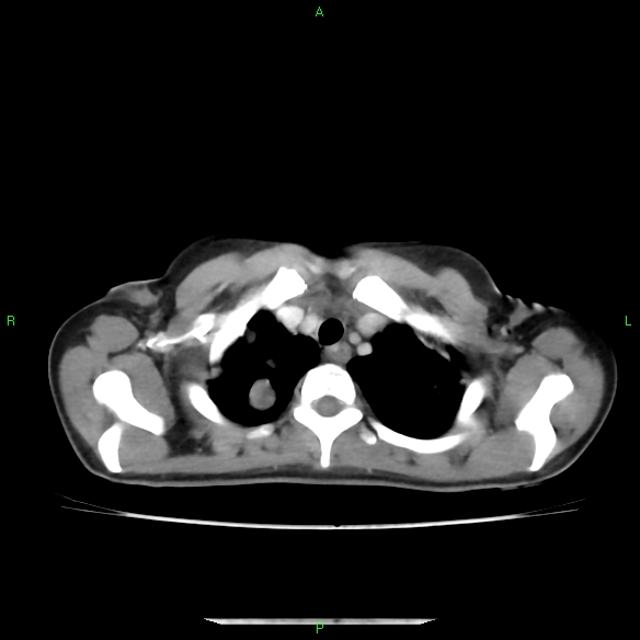 File:Cannon ball metastases - synovial sarcoma (Radiopaedia 26135-26271 C 6).jpg