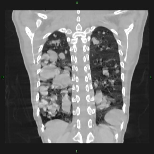 File:Cannon ball metastases - synovial sarcoma (Radiopaedia 26135-26271 Coronal lung window 18).jpg