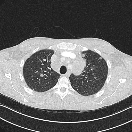 File:Cannonball metastases - testicular choriocarcinoma (Radiopaedia 84510-99891 Axial lung window 28).jpg