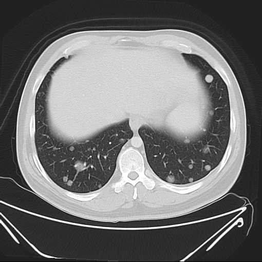 File:Cannonball pulmonary metastases (Radiopaedia 67684-77101 Axial lung window 21).jpg