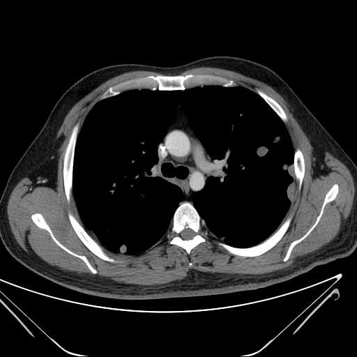 File:Cannonball pulmonary metastases (Radiopaedia 67684-77101 D 106).jpg