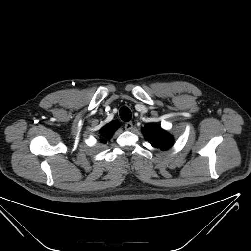 File:Cannonball pulmonary metastases (Radiopaedia 67684-77101 D 25).jpg