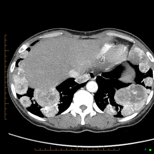 Canonball lung metastasis (Radiopaedia 77634-89837 B 84).jpg