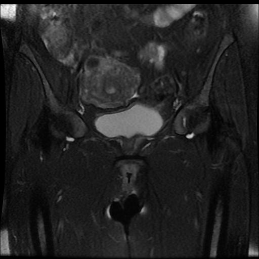 File:Carcinoma of the cervix (Radiopaedia 89018-105858 Coronal T2 fat sat 5).jpg