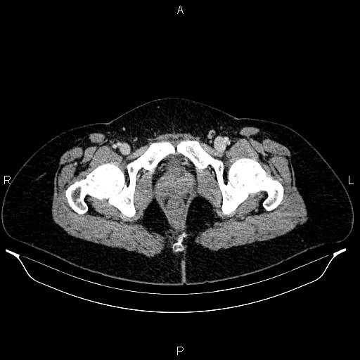 File:Carcinoma of uterine cervix (Radiopaedia 85861-101700 A 75).jpg