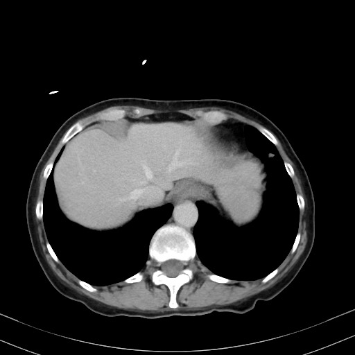 Carcinosarcoma (Radiopaedia 70401-80503 A 9).jpg