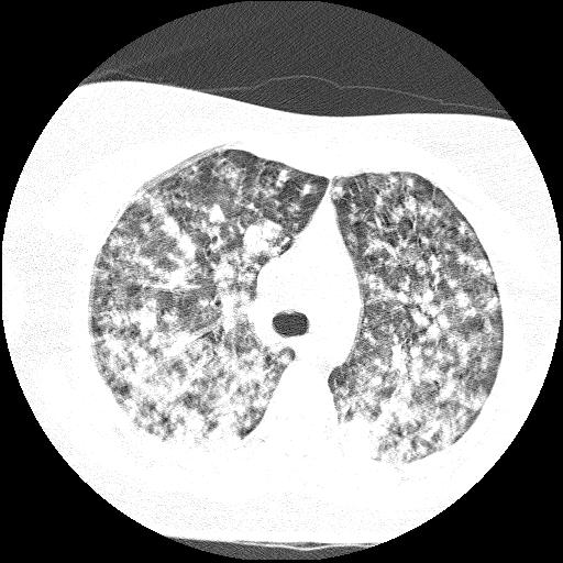 Cardiac angiosarcoma (Radiopaedia 66010-75181 Axial lung window 62).jpg