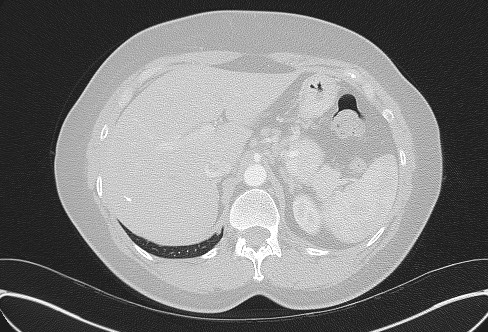 Cardiac sarcoidosis (Radiopaedia 74548-85534 Axial lung window 91).jpg