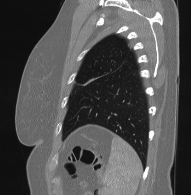 File:Cardiac sarcoidosis (Radiopaedia 74548-85534 Sagittal lung window 12).jpg