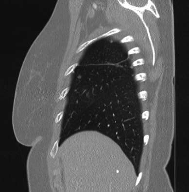 Cardiac sarcoidosis (Radiopaedia 74548-85534 Sagittal lung window 80).jpg