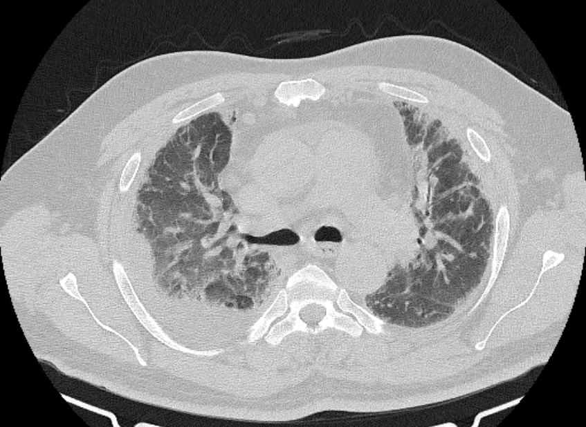 Cardiogenic pulmonary edema (Radiopaedia 68180-77678 Axial lung window 33).jpg