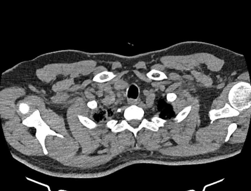 Cardiogenic pulmonary edema (Radiopaedia 68180-77678 Axial non-contrast 1).jpg