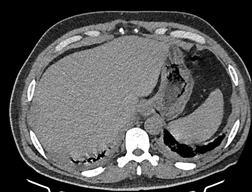 Cardiogenic pulmonary edema (Radiopaedia 68180-77678 Axial non-contrast 49).jpg