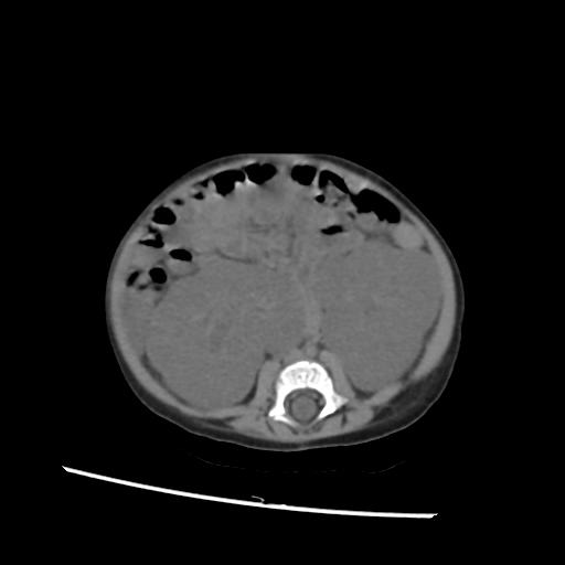 File:Caroli disease with autosomal recessive polycystic kidney disease (ARPKD) (Radiopaedia 89651-106703 Axial non-contrast 36).jpg
