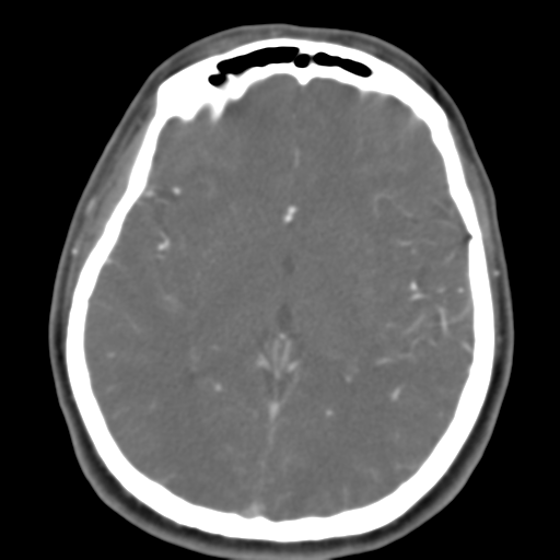 Carotico ophthalmic aneurysm (Radiopaedia 42916-46148 A 28).png