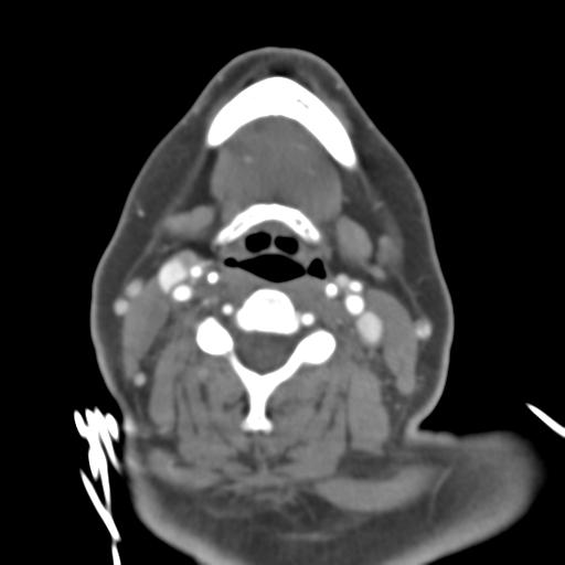 Carotico ophthalmic aneurysm (Radiopaedia 42916-46148 A 69).png