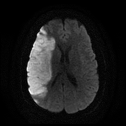 File:Carotid arterial dissection with acute cerebral infarction (Radiopaedia 26636-26784 Axial DWI 13).jpg