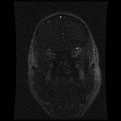 Carotid arterial dissection with acute cerebral infarction (Radiopaedia 26636-26784 MRV 125).jpg