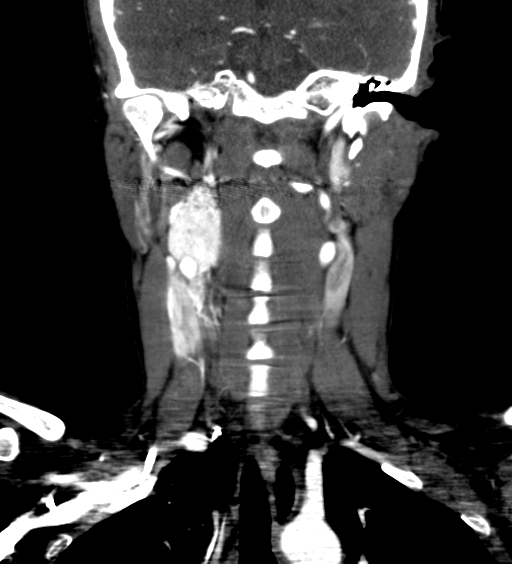 File:Carotid body tumor (Radiopaedia 39845-42300 C 42).jpg