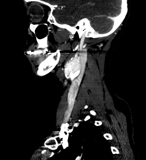 File:Carotid body tumor (Radiopaedia 39845-42300 D 17).jpg