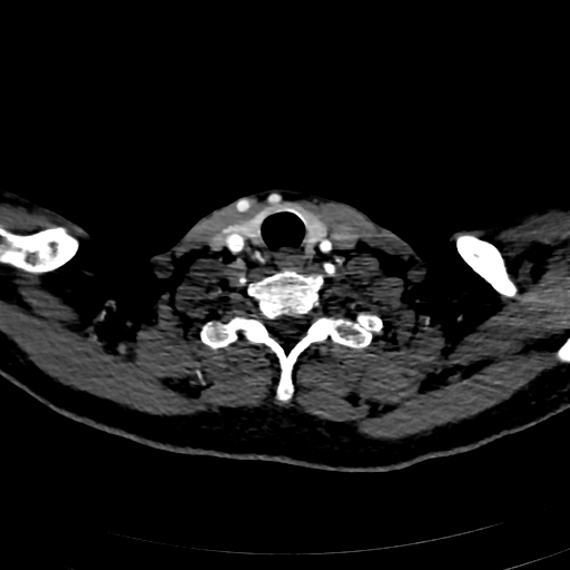 File:Carotid body tumor (Radiopaedia 83615-98727 A 96).jpg