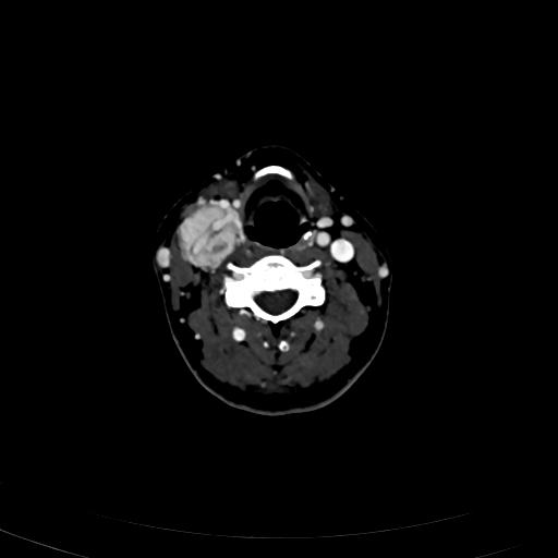 Carotid body tumor (Radiopaedia 83615-98727 D 66).jpg