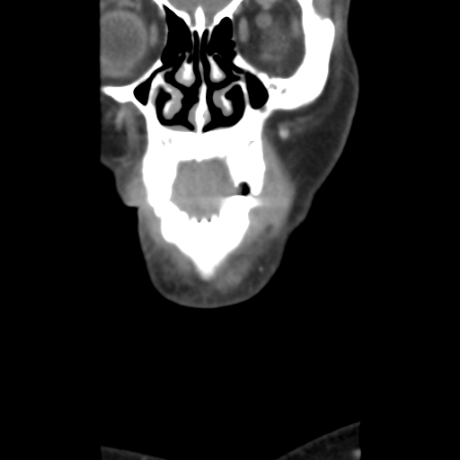 File:Carotid body tumor (paraganglioma) (Radiopaedia 38586-40729 B 6).jpg