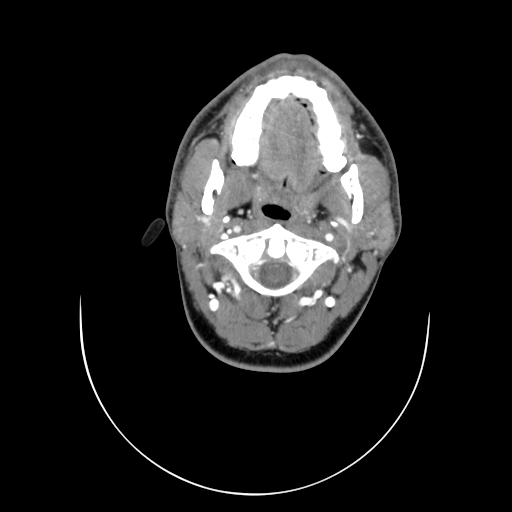 File:Carotid bulb pseudoaneurysm (Radiopaedia 57670-64616 A 14).jpg