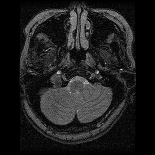 Cavernoma, DVA and right ICA aneurysm (Radiopaedia 33890-35072 E 101).png