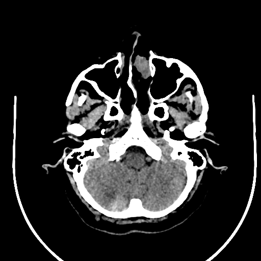 Cavernous hemangioma of the cerebellar falx (Radiopaedia 73025-83723 Axial non-contrast 20).jpg
