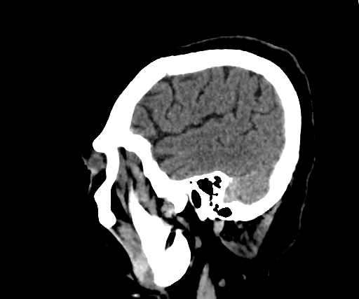Cavernous hemangioma of the cerebellar falx (Radiopaedia 73025-83723 B 60).jpg