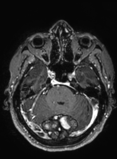 Cavernous hemangioma of the cerebellar falx (Radiopaedia 73025-83724 Axial T1 C+ 239).jpg