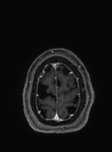 Cavernous hemangioma of the cerebellar falx (Radiopaedia 73025-83724 Axial T1 C+ 40).jpg
