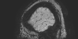 Cavernous hemangioma of the cerebellar falx (Radiopaedia 73025-83724 Sagittal BOLD 14).jpg