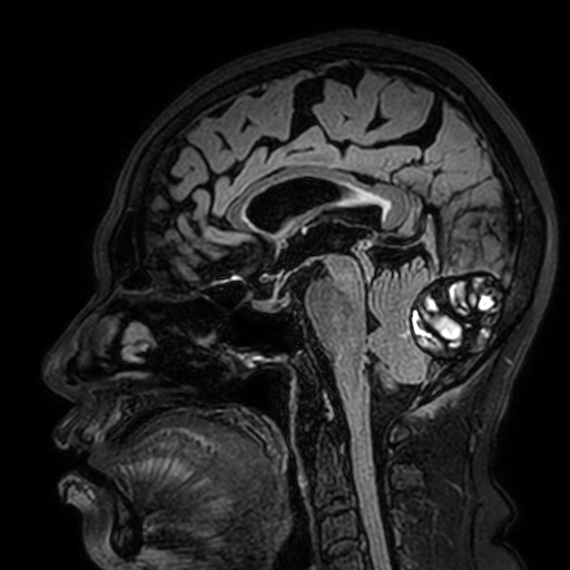 Cavernous hemangioma of the cerebellar falx (Radiopaedia 73025-83724 Sagittal FLAIR 106).jpg