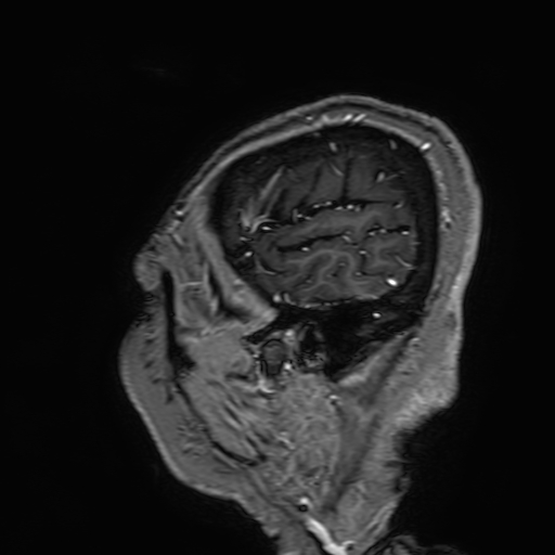 File:Cavernous hemangioma of the cerebellar falx (Radiopaedia 73025-83724 Sagittal T1 C+ 21).jpg