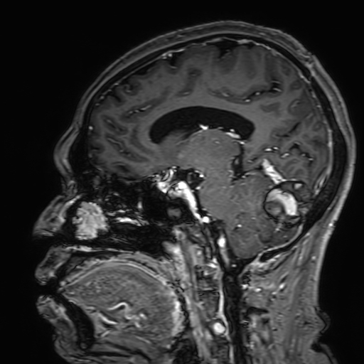 Cavernous hemangioma of the cerebellar falx (Radiopaedia 73025-83724 Sagittal T1 C+ 92).jpg
