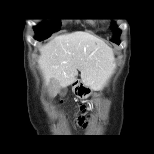 Cavernous hepatic hemangioma (Radiopaedia 75441-86667 C 28).jpg