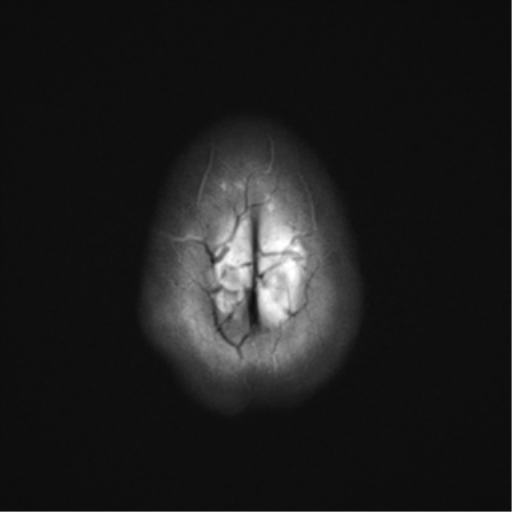 File:Cavernous malformation (cavernous angioma or cavernoma) (Radiopaedia 36675-38237 Axial T2 22).png